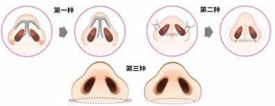 做鼻翼縮小手術(shù)前要什么準備