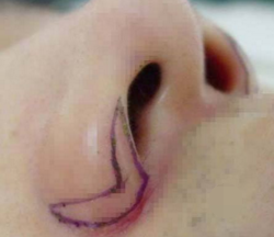 鼻翼縮小手術(shù)常見的風(fēng)險