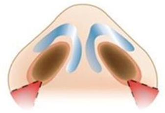  鼻翼縮小手術(shù)會(huì)有疤痕嗎