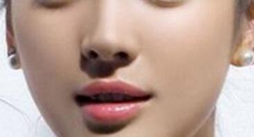 假體隆鼻的費(fèi)用是多少呢