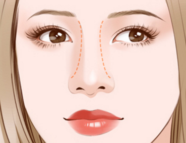 假體隆鼻術(shù)后的恢復(fù)期影響正常工作嗎