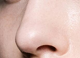 做隆鼻的恢復(fù)時間要多久