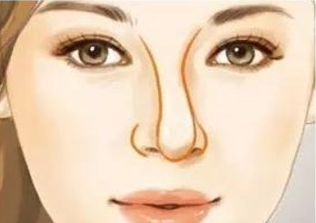 隆鼻后鼻子歪斜了怎么辦