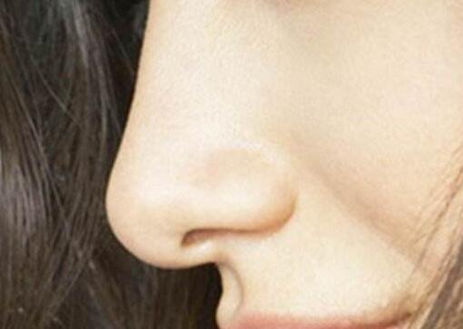 隆鼻后鼻子歪斜了怎么辦