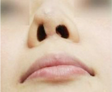 假體隆鼻失敗會有什么表現(xiàn)