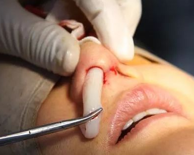 什么情況下要取出隆鼻假體