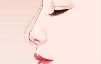 自體軟骨隆鼻失敗了還能修復(fù)嗎