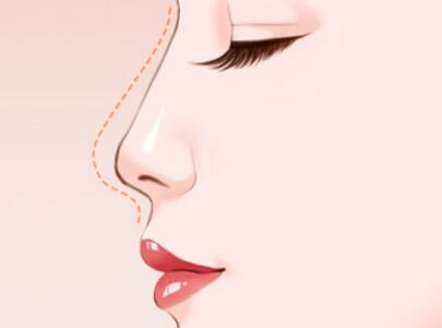 做自體軟骨隆鼻的優(yōu)點(diǎn)