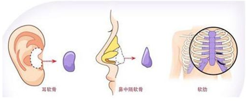 在廣州做自體軟骨隆鼻貴不貴