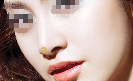 自體軟骨隆鼻失敗還能修復(fù)嗎