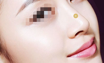 自體軟骨隆鼻恢復(fù)期間能正常上班嗎