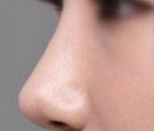 自體肋軟骨隆鼻到底好不好