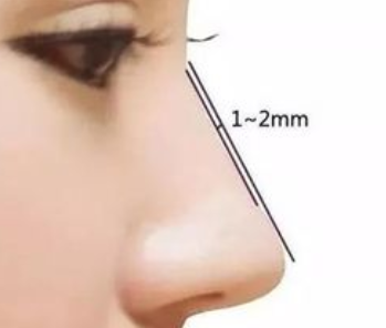 自體軟骨隆鼻受歡迎的原因