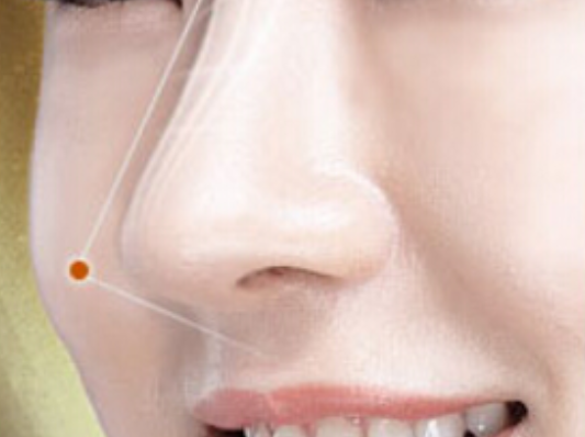 軟骨隆鼻手術(shù)的優(yōu)點有哪些