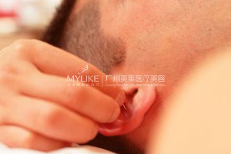 高建華醫(yī)生真實(shí)案例:耳朵再造