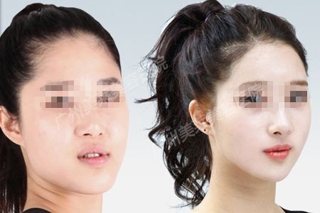 下頜角磨骨效果怎么樣?