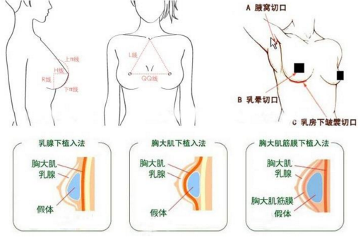 假體隆胸是在哪做切口的