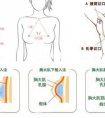 假體隆胸是在哪做切口的