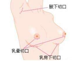 假體隆胸后手感硬是怎么回事