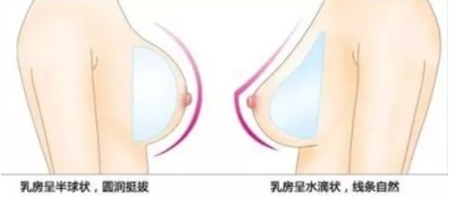 假體隆胸后外形自然嗎