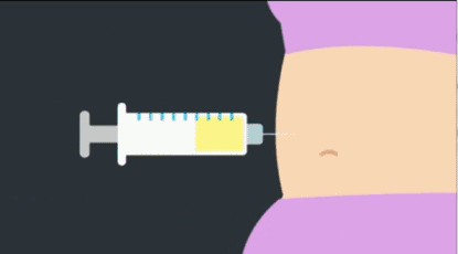 做自體脂肪隆胸需要住院嗎