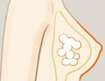 自體脂肪豐胸后會影響哺乳健康嗎