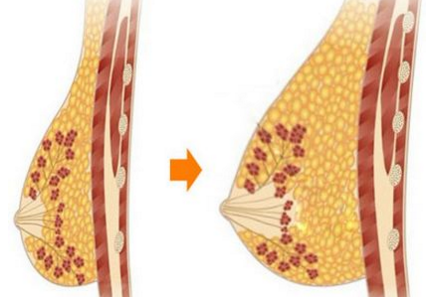 做自體脂肪豐胸的價(jià)格什么因素影響