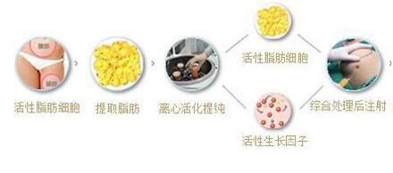 自體脂肪隆胸的價格受什么因素影響