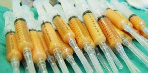 自體脂肪隆胸有缺點嗎