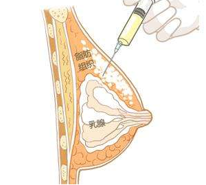 自體脂肪豐胸時間長了效果會消失嗎