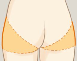 臀部吸脂手術(shù)后多久能坐