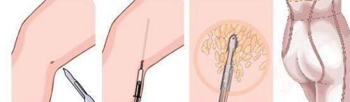 吸脂減肥會(huì)有副作用嗎
