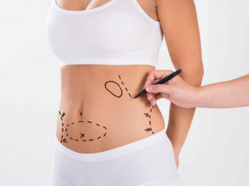 吸脂減肥后會有血腫嗎