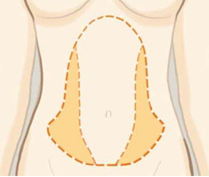 吸脂減肥術(shù)后需要按摩嗎