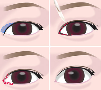 眼角開得過大會有什么癥狀嗎