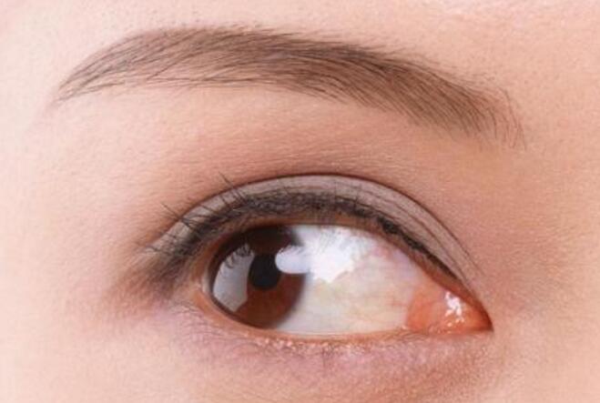 開眼角手術是不是越大越好看呢