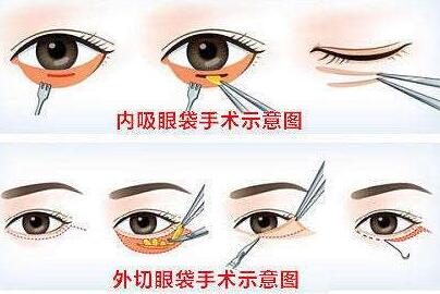 開眼角手術是不是越大越好看呢