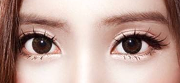 開眼角手術(shù)一般需要多少錢