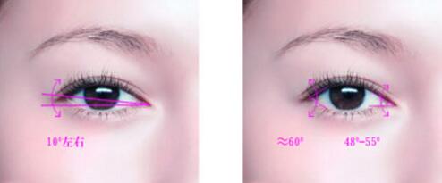 開眼角常見的后遺癥風險