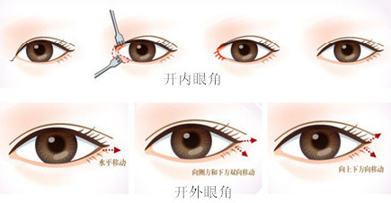 開眼角常見的后遺癥主要有哪些