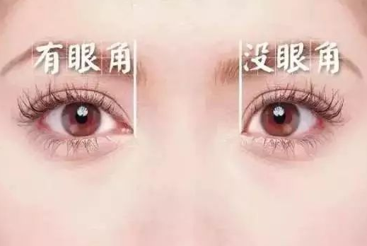 開眼角手術(shù)一般多少錢