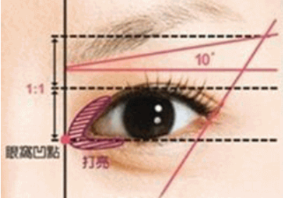 開眼角的價格受哪些因素影響