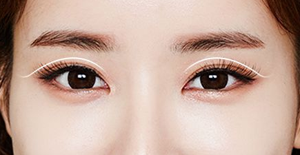 做雙眼皮手術(shù)出現(xiàn)疤痕了怎么辦