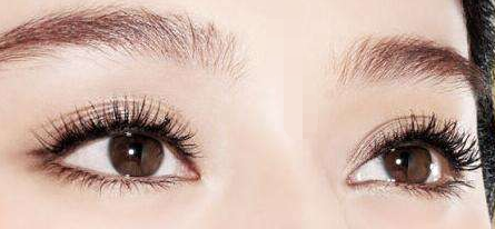 雙眼皮手術(shù)會失敗嗎