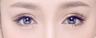 全切雙眼皮術(shù)后需要注意的護(hù)理事項(xiàng)