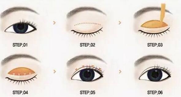 全切雙眼皮術(shù)后需要注意的護(hù)理事項(xiàng)