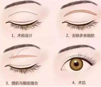 做雙眼皮手術(shù)會有什么風險
