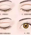 做雙眼皮手術會有什么風險
