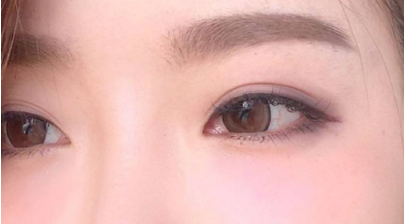 全切雙眼皮術后會影響工作嗎