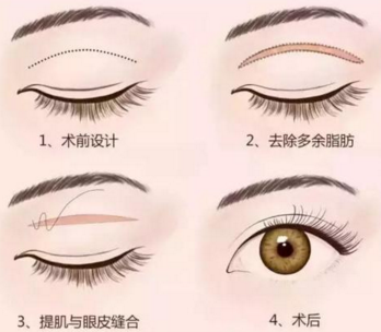 全切雙眼皮會(huì)影響視力健康嗎